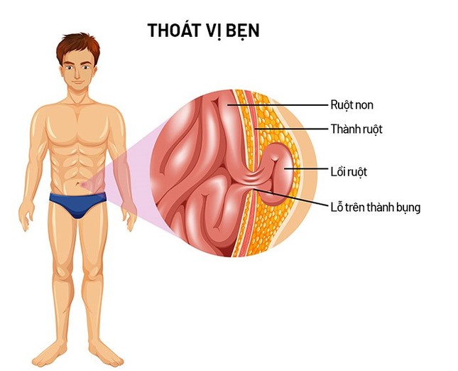  Thoát vị bẹn – chữa sớm khỏi sớm 